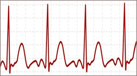 Électrocardiogramme et Méditation Transcendantale