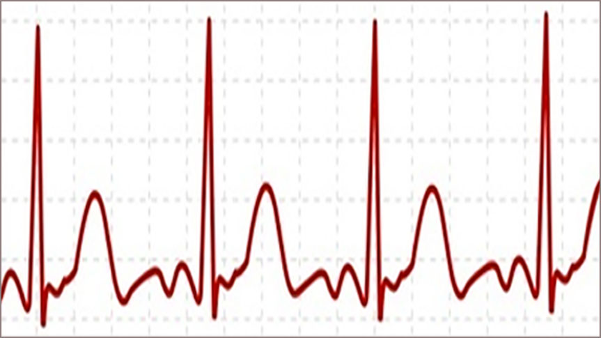 Graphique illustrant un électrocardiogramme pour Méditation Transcendantale